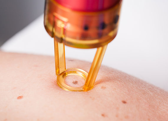 Natural Herbal Serum for micro and nano needling 