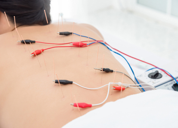 Electro acupuncture