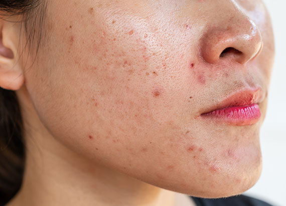 Traditional Chinese Medicine & Microneedling